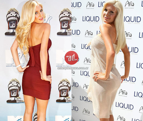 heidi-montag-butt-implants