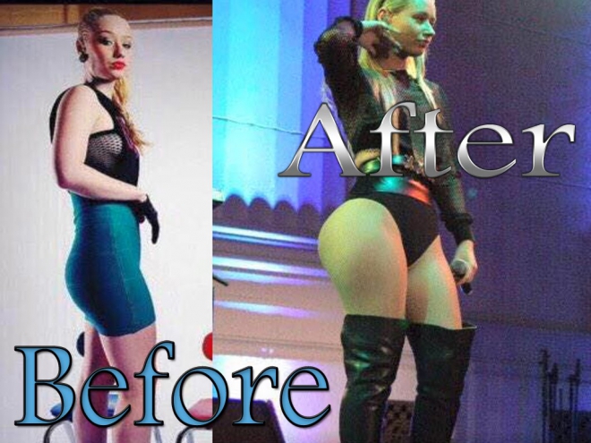 iggy-azalea-butt-implants