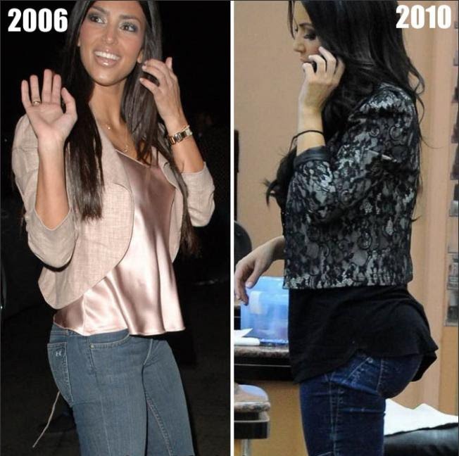 kim-kardashian-butt-implants