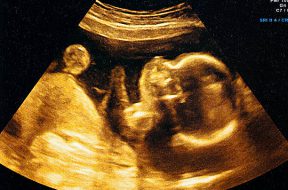 Fetus ultrasound at 24 weeks