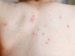 Chickenpox on a little boy's back